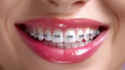 Teeth Braces Cost in Bengaluru